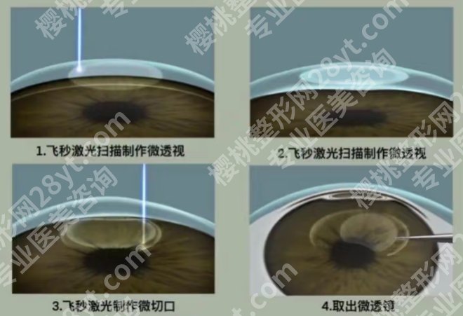 哈尔滨医大一有全飞秒激光吗？医院优势详情客户口碑超好！