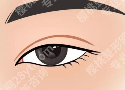 割双眼皮的后遗症和副作用是什么?这些隐患要当心