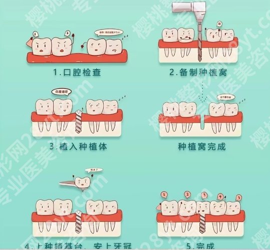 济宁人民医院种牙多少钱？2025版项目收费明细参考!