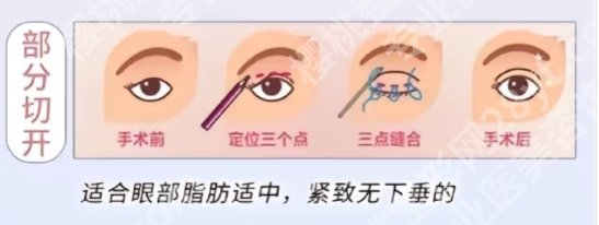 南方医科大学深圳医院双眼皮和南方医院哪个好？医院具体资料信息！