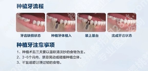 哈尔滨种植牙哪个医生好？其中王屹博|袁峰|齐峰等医生都很不错！