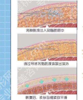 北华大学附属医院整形外科吸脂多少钱？医院医生详细介绍！
