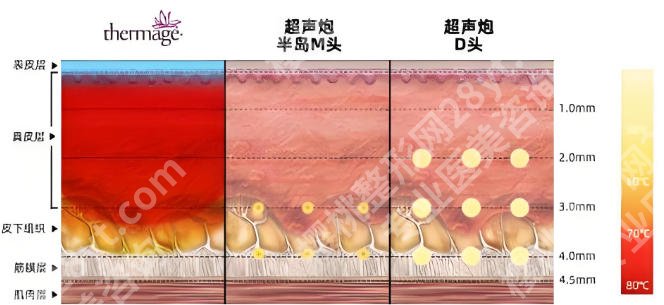 成都军大的黑钻超声炮怎么样？医院优势详情！