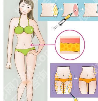 南京美莱吸脂怎么样？明星项目以及医院详细盘点！点击浏览