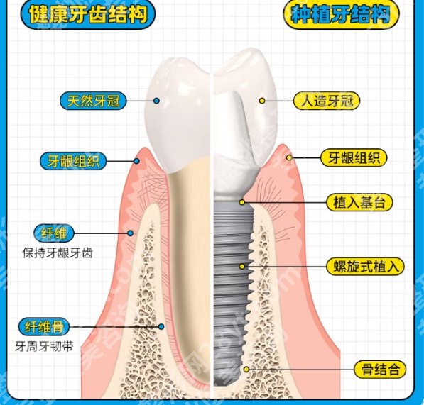 深圳牙齿种植价格如何？医院价格表一览！收藏再看