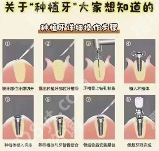 深圳牙齿种植医院排名更新啦!新鲜出炉的一手资料!一起来看看吧