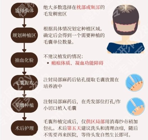 连云港植发哪家便宜又好?下文几家人气高的机构等你来选!