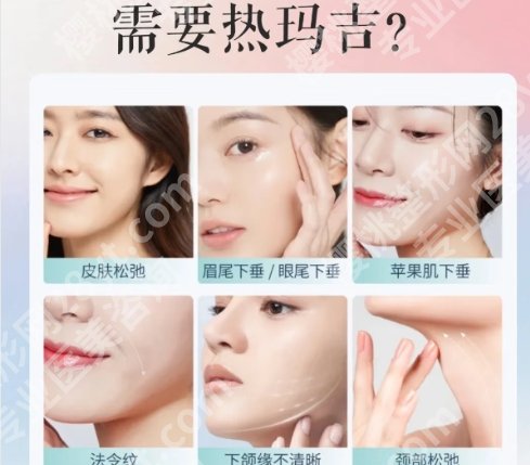 北医三院热玛吉怎么样？效果好不好？真人案例展示！