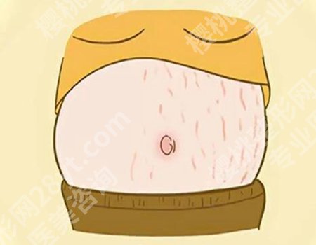 去妊娠纹激光多少钱?费用背后的惊人真相速看