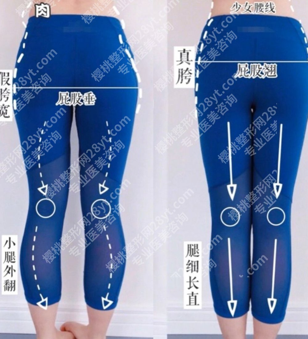 o型腿部塑形医美，不是天生笔直，也能后天修饰