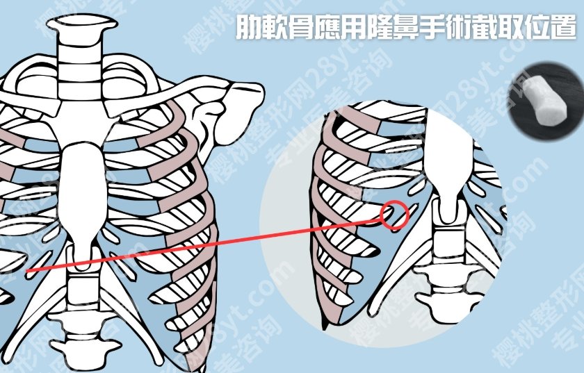 肋软骨隆鼻可以维持一辈子吗？效果长久≠一劳永逸，时间问题没那么简单