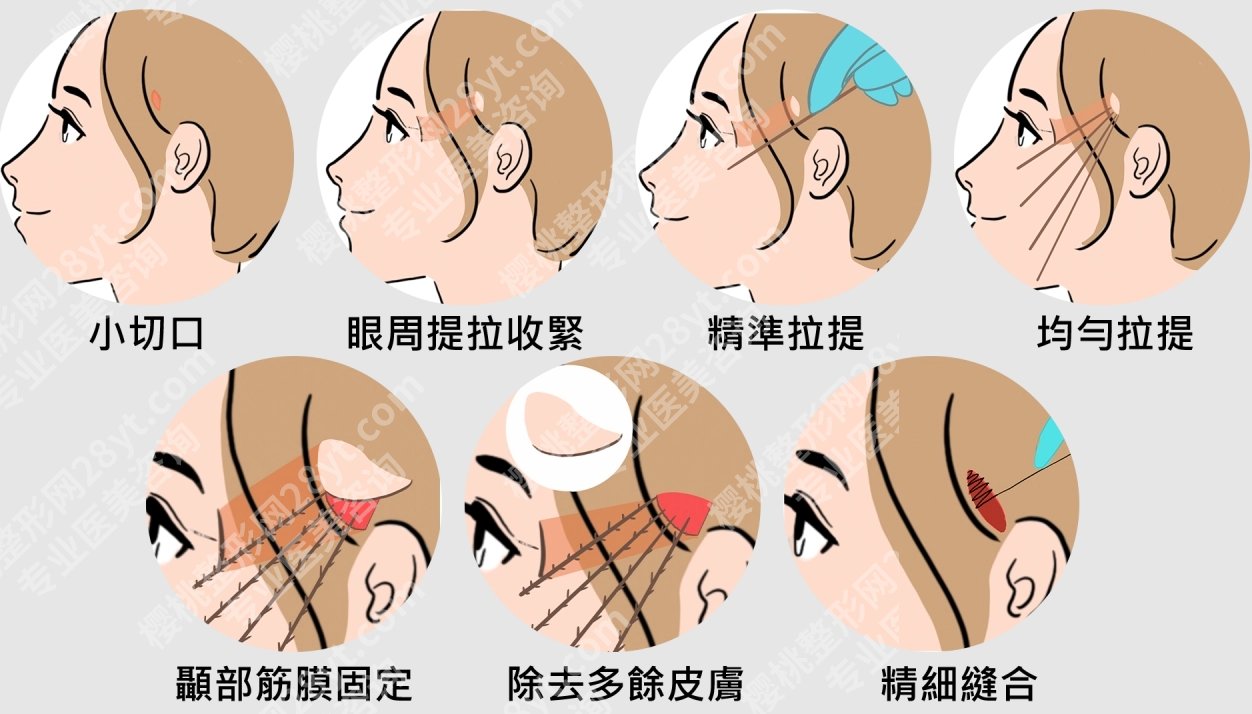 筋膜提升手术提升全过程，一篇文章带你走完全流程，知道值不值得