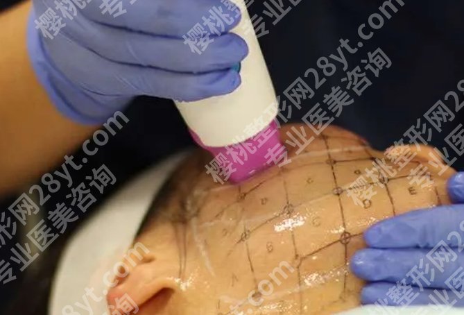 热玛吉一年后会更松吗?实测经验+医生说法都在这