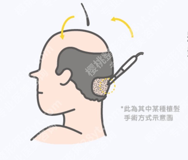 青岛植发医院排名，真人案例+实操体验，避坑不求人