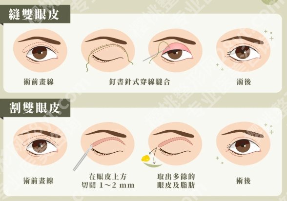 双眼皮一个月和三个月，恢复进度条全解析，新手别被前期状态吓退