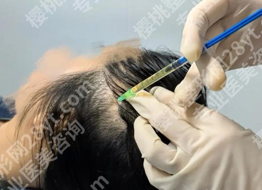 cgf脱发价格是多少?费用详情曝光,一文带你看明白
