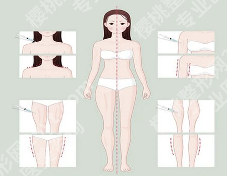 吸脂一个部位多少钱?影响因素+不同部位报价,费用透明化