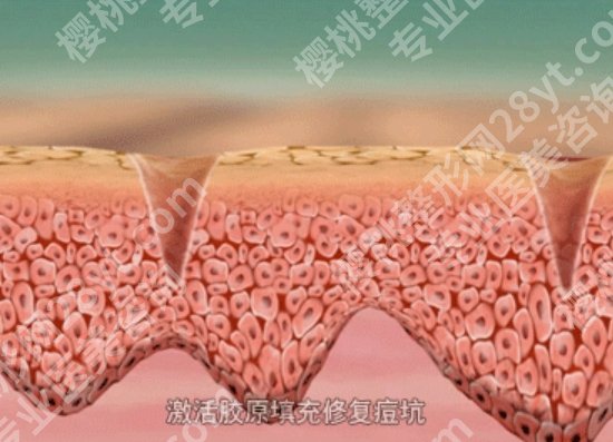 做点阵激光多久可以恢复？熬过这14天，皮肤真的像新生！恢复指南