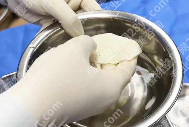 生物补片早射微创手术可以维持多久？耐用度横评：理论值vs实际反馈