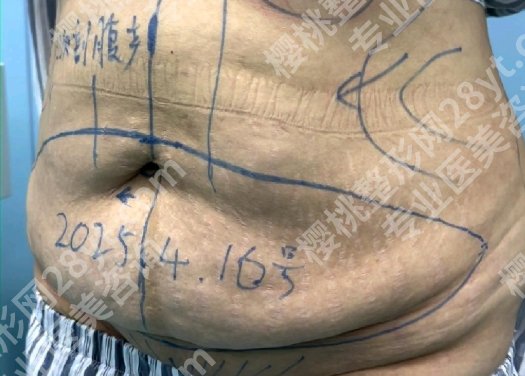 南京腹壁整形哪个专家厉害些？腰腹塑形不容易，找对专家更关键
