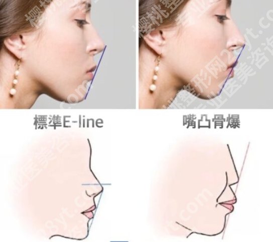 骨性嘴凸和牙性嘴凸怎么区别，笑起来怪怪的？先别自卑，可能只是“结构出问题”！