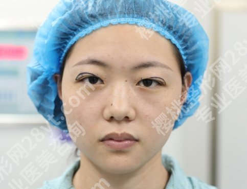双眼皮修复是重新割吗？“翻车”后还能逆袭？修复操作了解一下！