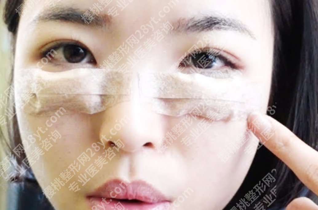 做眼袋手术有必要吗？别让它拖垮你的颜