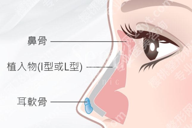软骨隆鼻可以一辈子吗？不同医生回答不一样，软骨隆鼻寿命揭秘