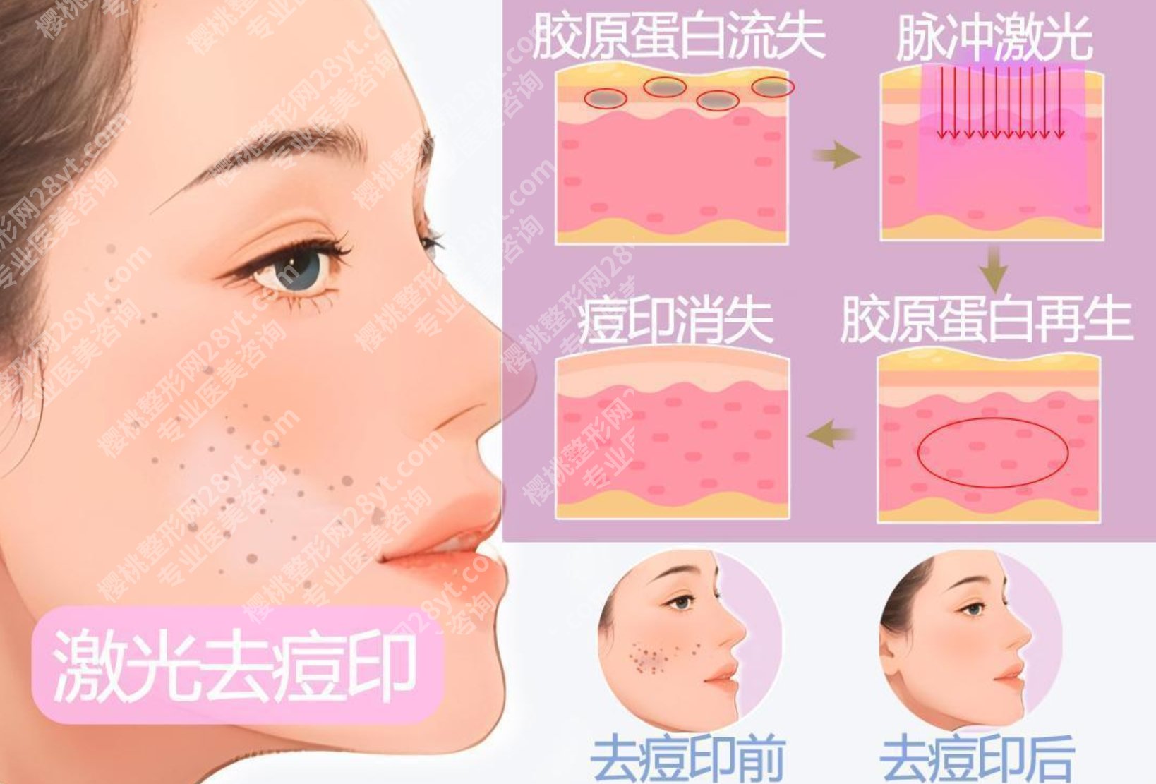 激光祛痘印有效果吗？亲身试过之后才敢说｜效果比想象中靠谱