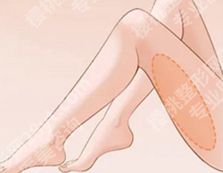 哈尔滨医大医美注射瘦腿全解析，案例见证，原理大揭秘