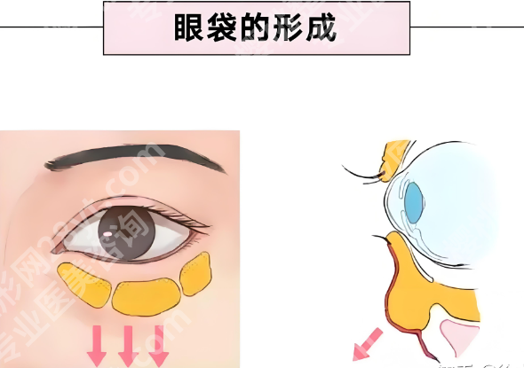 怎样才能彻底去除眼袋？5种方法对比，告别眼袋不反弹攻略