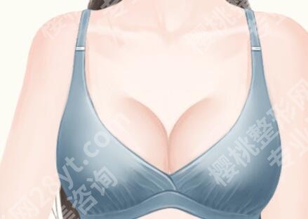 毛面假体和光面假体哪个好？核心区别分析，看完这篇不纠结