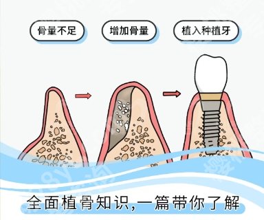 山西省人民医院种牙技术好不好？医院简介|经典案例图反馈！