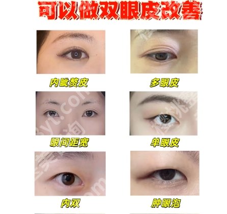 哈医大一院双眼皮怎么样？网友经典案例图展示！