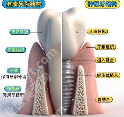 南京人民医院种植牙多少钱？2025项目收费标准更新！