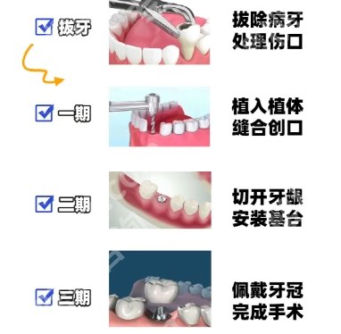 蛇口人民医院种牙多少钱？2025收费标准更新！戳进来看