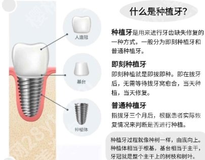 中大口腔种植牙价格表参考！瑞士ITI种植牙5100元起~