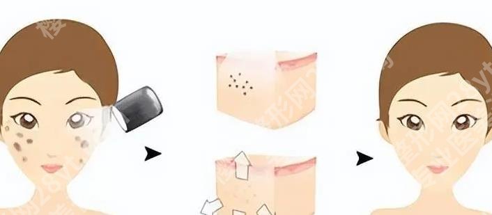 沈阳七院光子嫩肤怎么样？嫩肤手术案例及术后tips分享！
