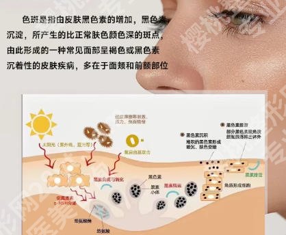 芜湖二院整形科医院祛斑多少钱?费用标准更新!