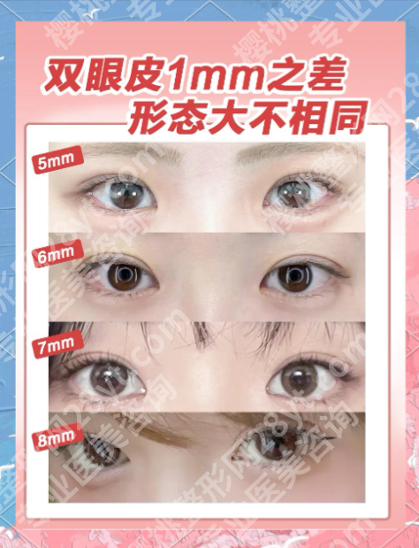 汕头附一蔡湘娜双眼皮怎么样？内附真实案例+价格表，肿眼泡宝子亲测不踩坑！