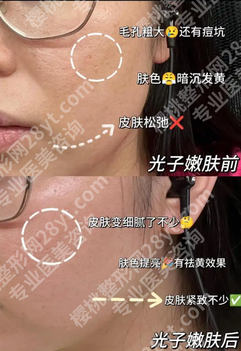 301医院可以做光子嫩肤吗？揭秘三甲医院光子嫩肤的“隐形优势”