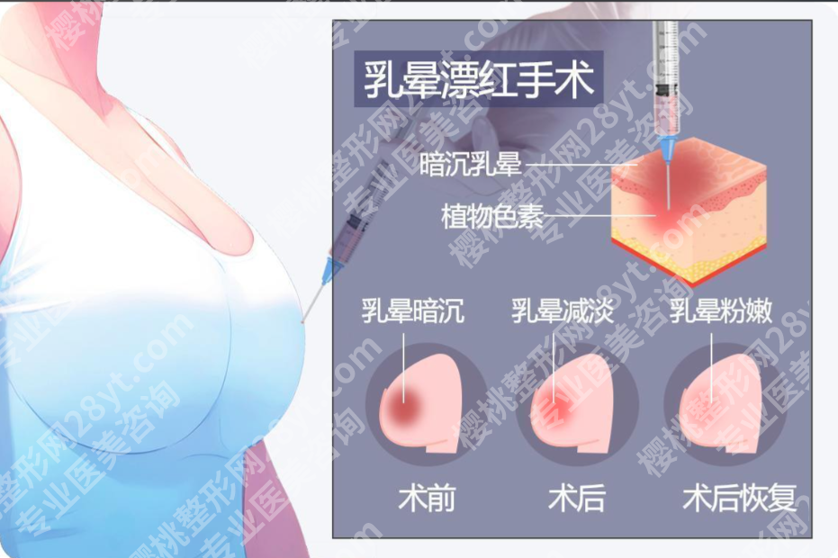 乳晕整形术要多少钱？价格背后的门道你必须知道