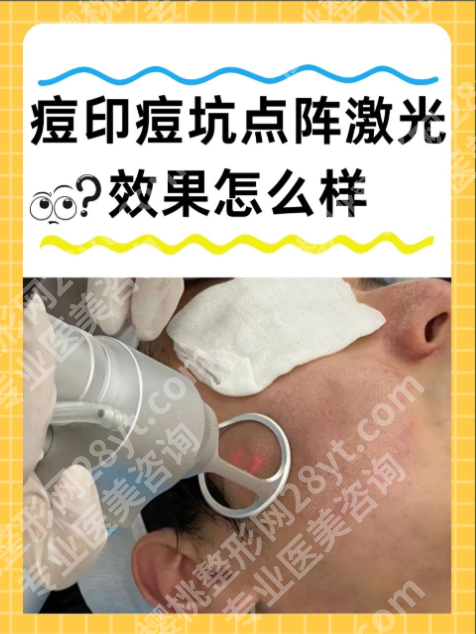 广东省皮肤病医院点阵激光怎么样?真人实测祛疤/祛痘/祛斑全攻略