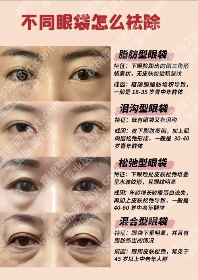 蚌埠哪家医院做眼袋比较好？医院实测+2025 价格表揭秘