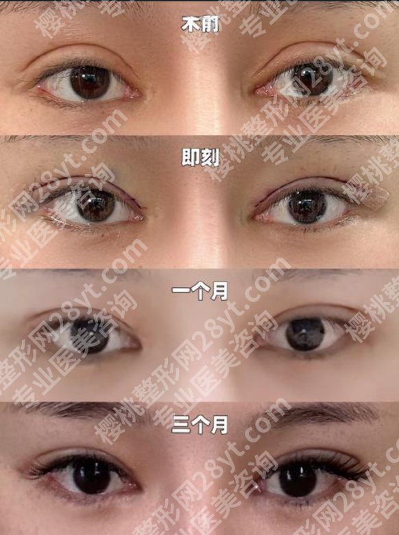 珠海人民医院双眼皮医生案例全解析，看完放心变美！