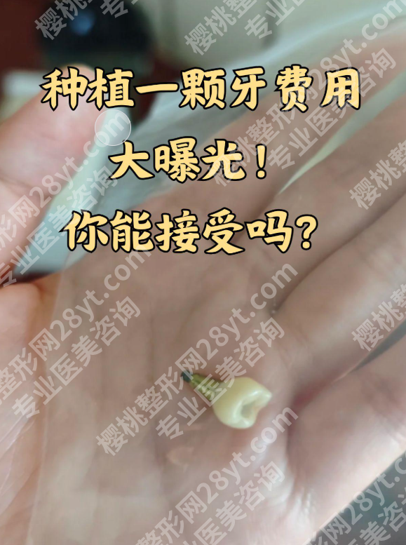 中山三院种植牙贵吗？别再瞎问了！中山三院种植牙价格全揭秘