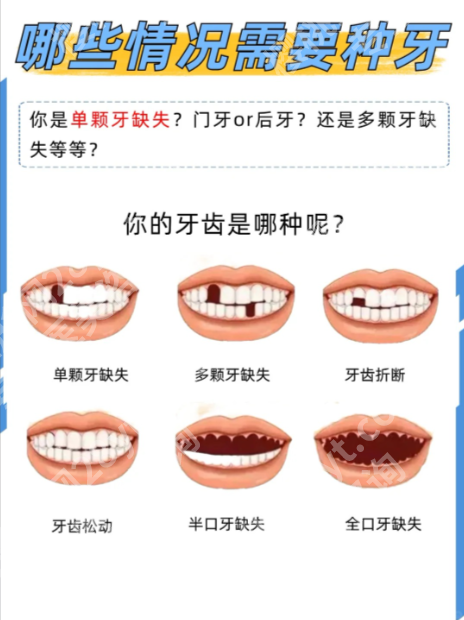 重庆医科大学附属第一医院种植牙怎么样?实力大揭秘,种牙不踩坑!