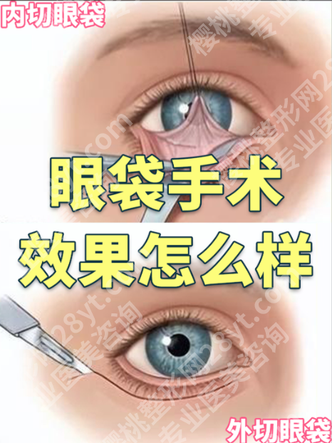 苏州附二院去眼袋手术全攻略:从技术到案例,告别“肿泡眼”