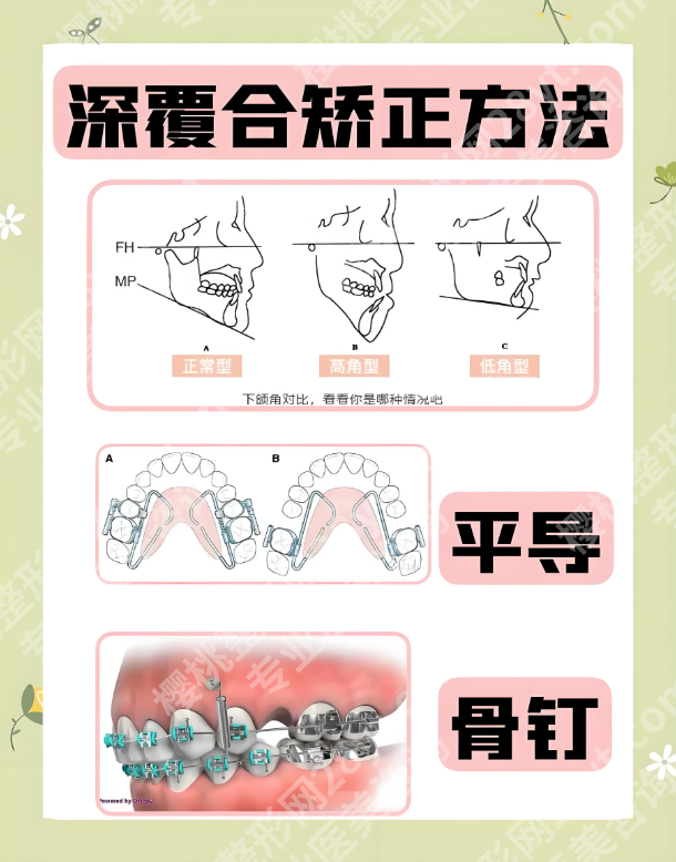矫正深覆合要拔牙吗？3类案例+2张表，帮你搞懂“拔与不拔”的关键
