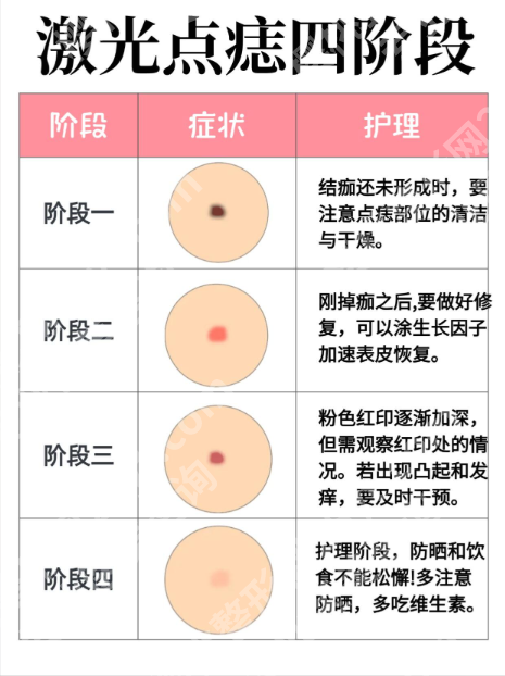 广州珠江医院美容科激光点痣好不好？2025真实案例+价格表，怕留疤的姐妹必看！